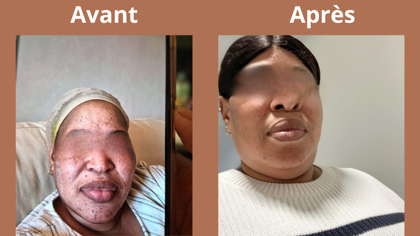 Crème anti hyperpigmentation