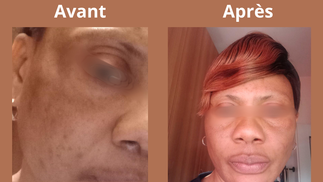Crème anti hyperpigmentation