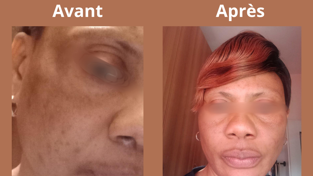 Crème anti hyperpigmentation